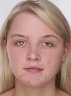 El Eliminador de Acné Definitivo